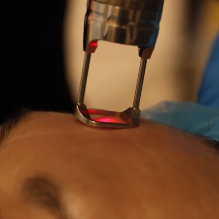 fotona 4d tratamiento para rejuvenecer en hermosillo sonora mexico