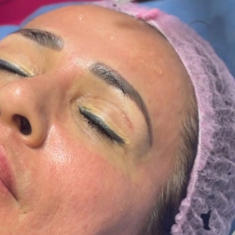 tratamiento estético pdrn en hermosillo, sonora, mexico